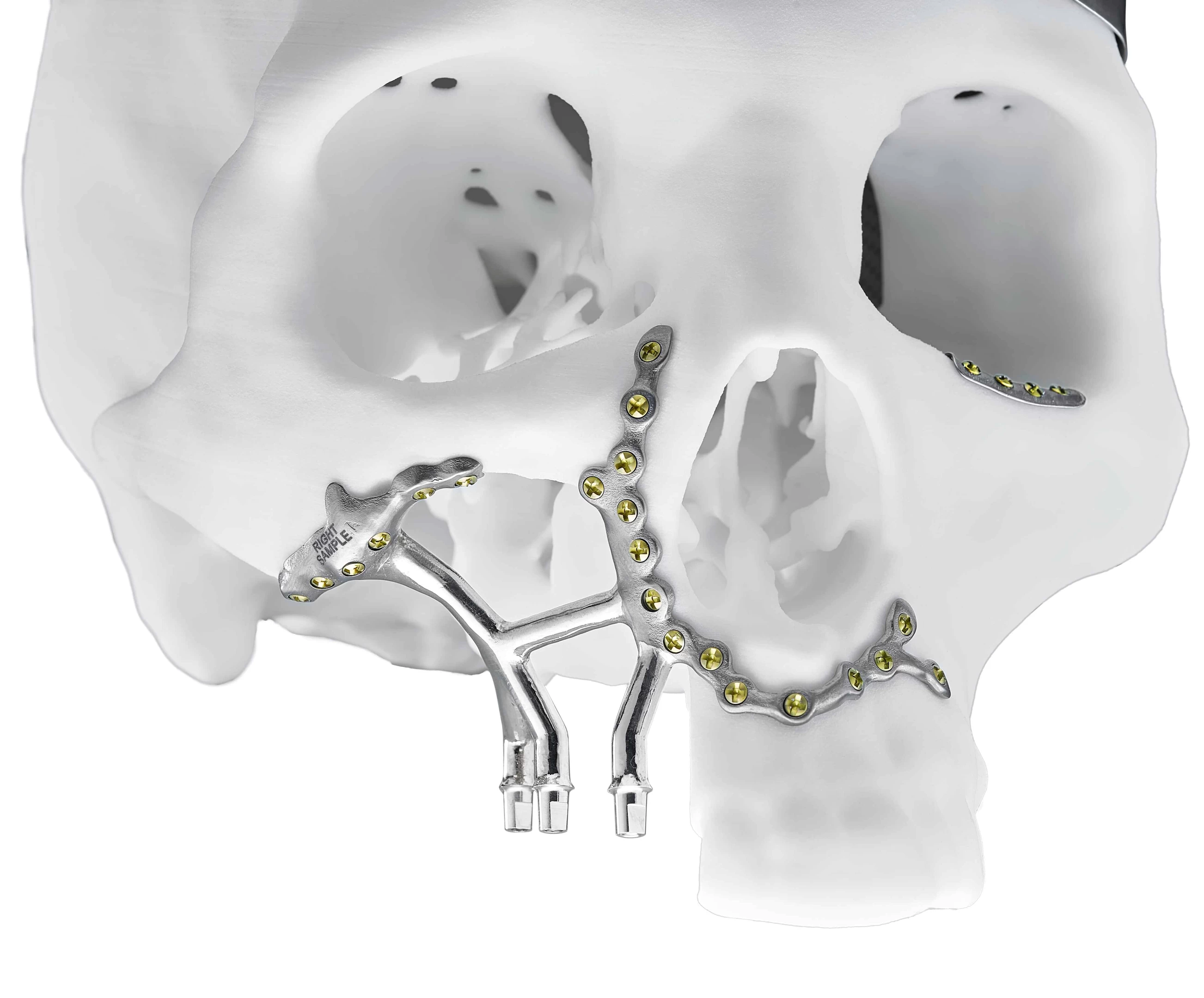 Cranial Implants